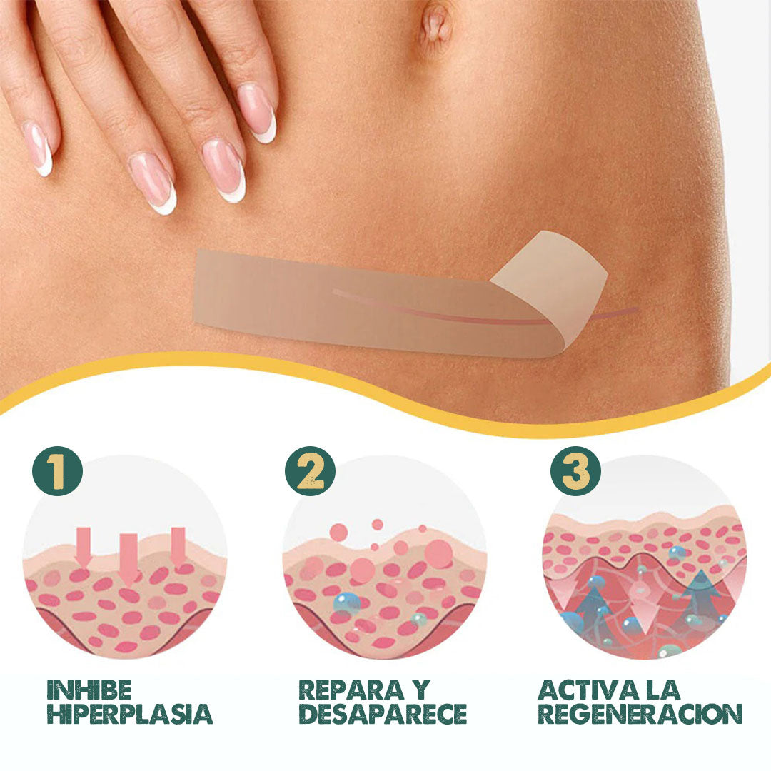 Silicone Marks Sheet | Elimina marcas en la piel en semanas