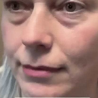 Micro-Infusion Patches - Mirada más joven y radiante