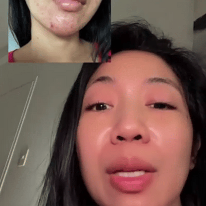 Silicone Acné Sheet | Elimina el acné en semanas