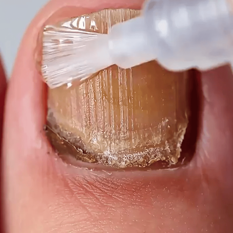 Footcure - Adiós en los hongos de las uñas