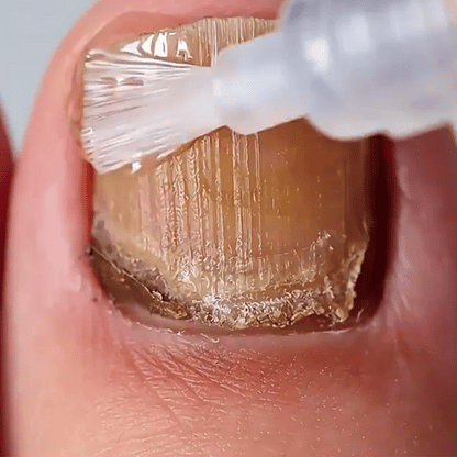 Footcure - Adiós en los hongos de las uñas