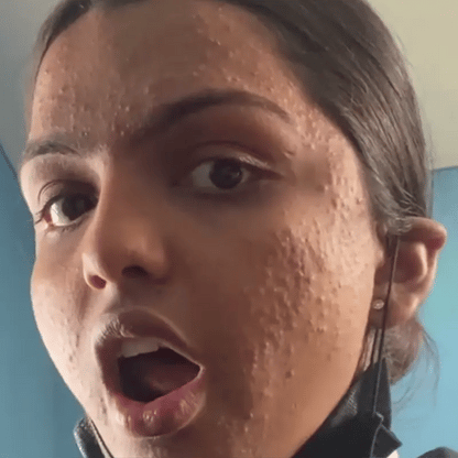 7 Days Acne Removal - Obten una Piel Sana y Lisa