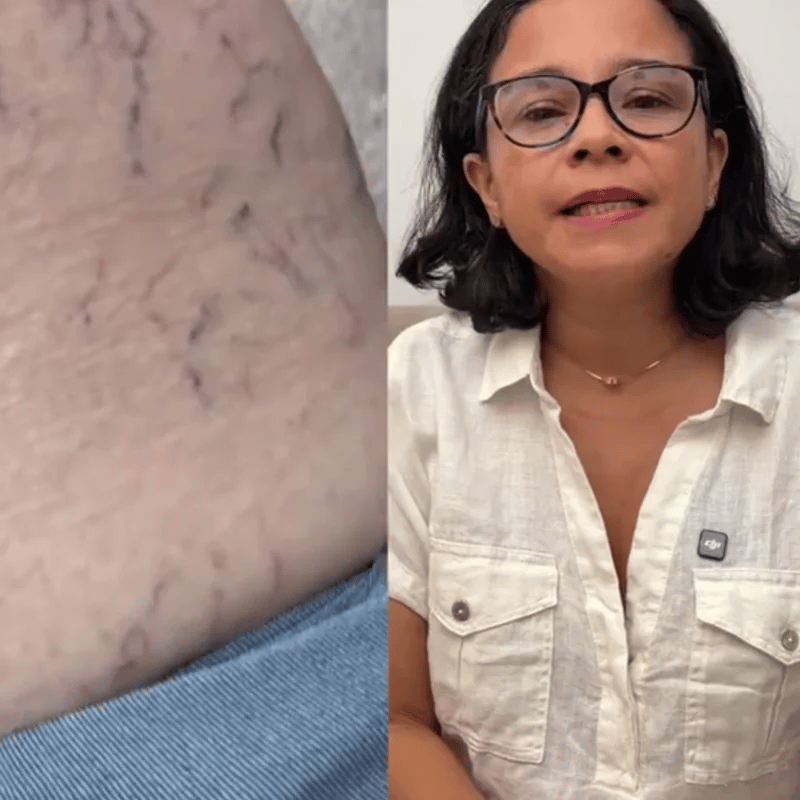 Liposomal Vitamin C - Mejora circulación y varices