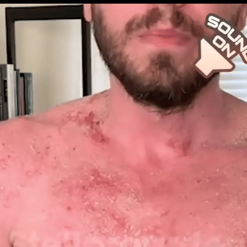 SPRAY PSORIASIS X2 UNIDADES | ALIVIO RÁPIDO DE PICAZÓN Y ARDOR