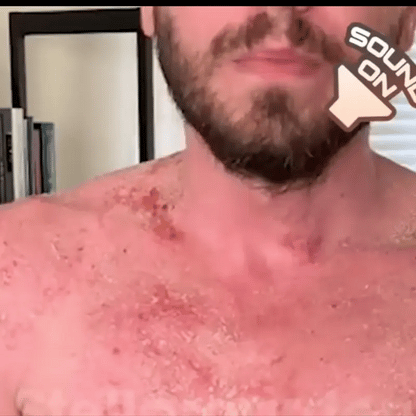 SPRAY PSORIASIS X2 UNIDADES | ALIVIO RÁPIDO DE PICAZÓN Y ARDOR
