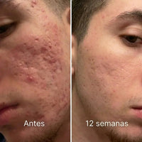 Pluune Barra de Silicona para Cicatrices: Adiós Acné, Estrías y Marcas - 2