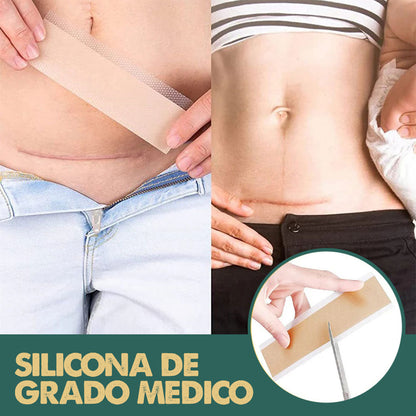 Silicone Scars Sheets | Adiós cicatrices y líneas de expresión desde la primera semana