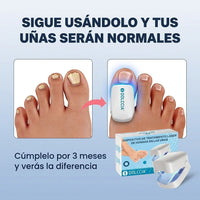 DOLCCIA® Laser de Uñas Portátil: Elimina Hongos en Casa Efectivamente - 9